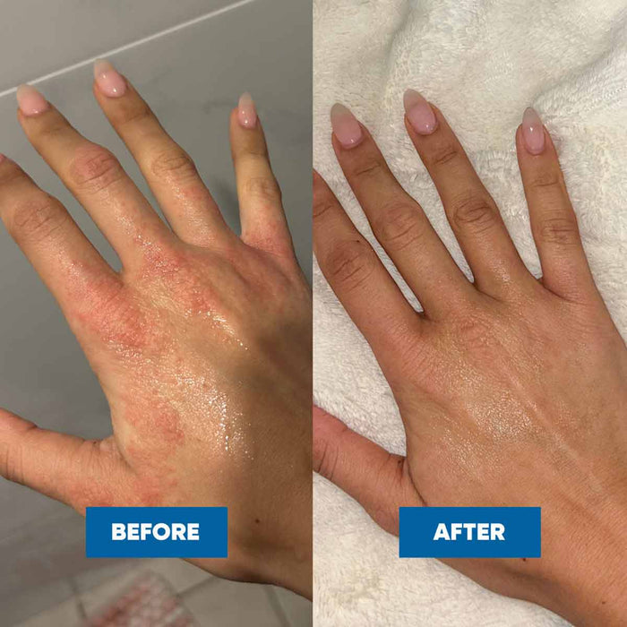 Before and after comparison of a hand with visible skin condition on a gray background.
