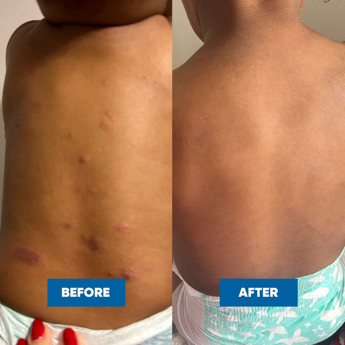 Before and after comparison of a person's back with visible improvements.